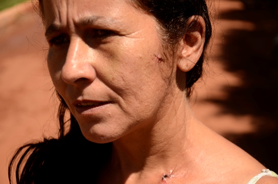Moradora exibe os pontos sobre os ferimentos resultantes de acidente ao cair em buraco em uma rua da cidade - Foto Luan Dourado/GazetaMT