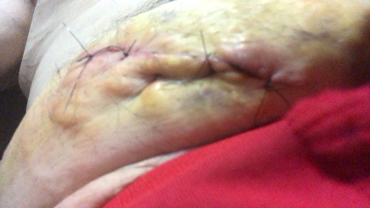 Local infeccionado onde foi feita cirurgia no novo hospital da Unimed em Rondonópolis: Intervenção teve que ser refeita