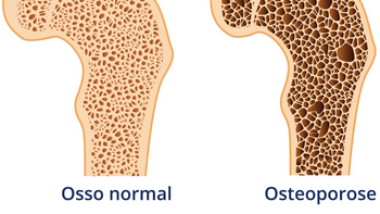 Osteoporose atinge cerca de 10 milhões de brasileiros 