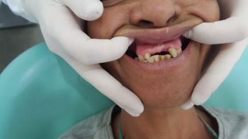 Consultório odontológico do Pedra 90 realiza mais de 3,5 mil atendimentos á moradores de rua 