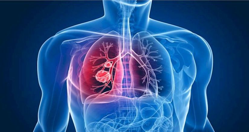 Estudo revela compostos que podem combater a tuberculose