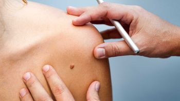 Mutirão de Prevenção ao Câncer de Pele será realizado no CEADAS