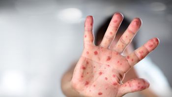 Mais de 3.800 crianças devem ser vacinadas contra sarampo em Primavera