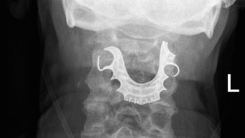 Dentadura é encontrada na garganta de homem uma semana após cirurgia