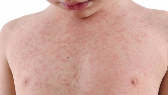 Perda de status de país livre de sarampo é retrocesso, diz pediatra