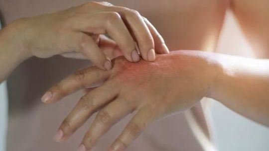 Psoríase | Conheça as causas e por que ela pode causar problemas no coração