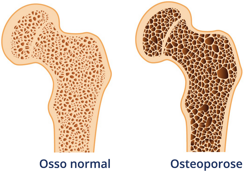 Osteoporose atinge cerca de 10 milhões de brasileiros 