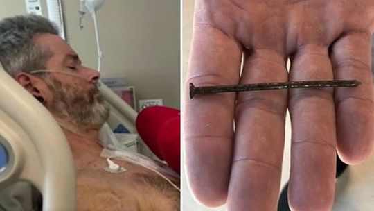 Carpinteiro sobrevive após prego de 7,5cm ficar cravado no coração 
