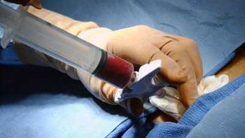 Transplante de medula óssea beneficia tratamento de 80 doenças