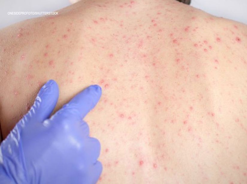 Ministério da Saúde atualiza casos de sarampo