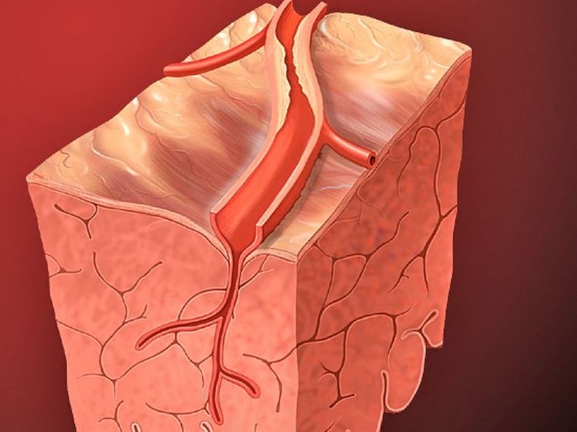 Estudo mostra que infarto pode acelerar declínio cognitivo
