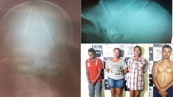 Bebê com agulhas no corpo recebe alta médica, confirma Santa Casa