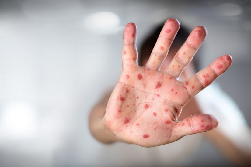 Mais de 3.800 crianças devem ser vacinadas contra sarampo em Primavera