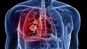 Nesta segunda tem pit stop de combate à tuberculose
