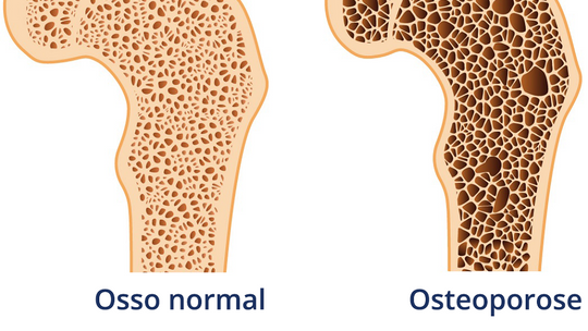 Osteoporose atinge cerca de 10 milhões de brasileiros 