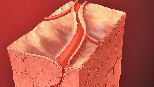 Estudo mostra que infarto pode acelerar declínio cognitivo