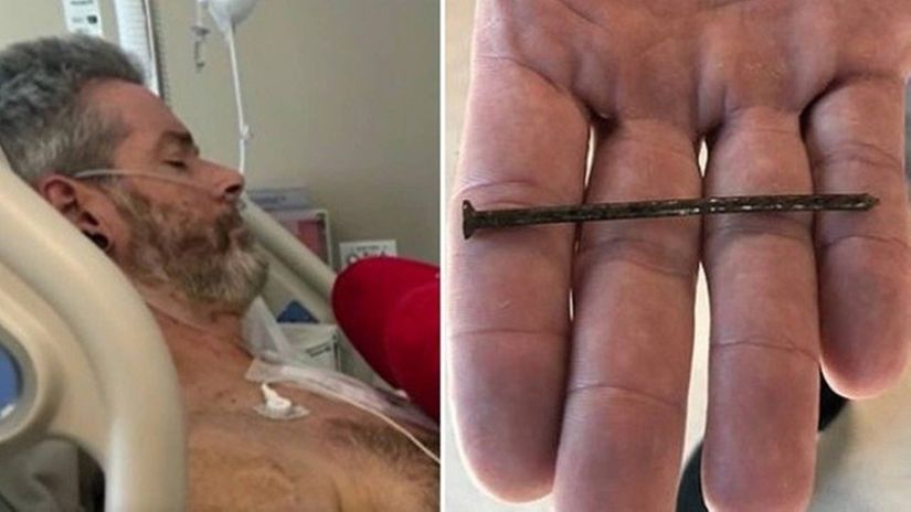 Carpinteiro sobrevive após prego de 7,5cm ficar cravado no coração 