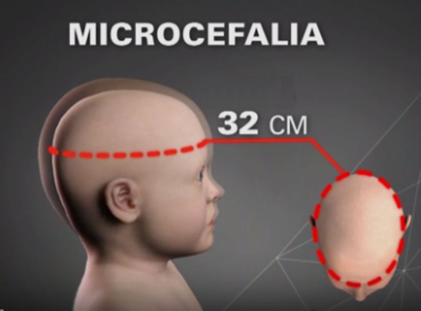 Sobe para 31 casos de microcefalia no Estado. Rondonópolis confirma 16
