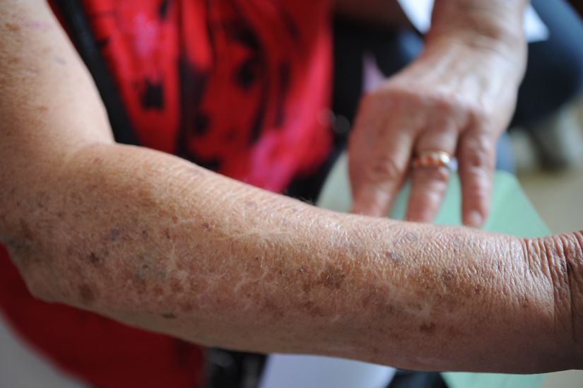 SMS e dermatologistas promovem mutirão contra o câncer de pele, neste sábado 30