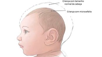  Vigilância Epidemiológica notifica novos casos suspeitos de microcefalia