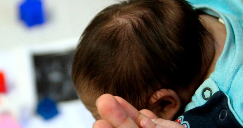 Notificações de casos suspeitos de microcefalia aumentam em Mato Grosso