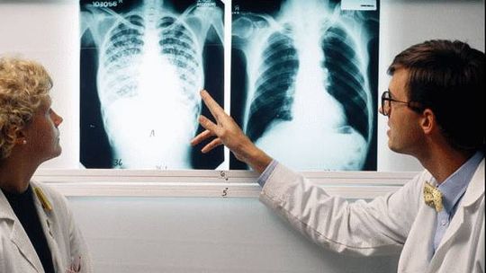 Saúde faz mutirão de exame da tuberculose neste sábado (23) na Praça dos Carreiros