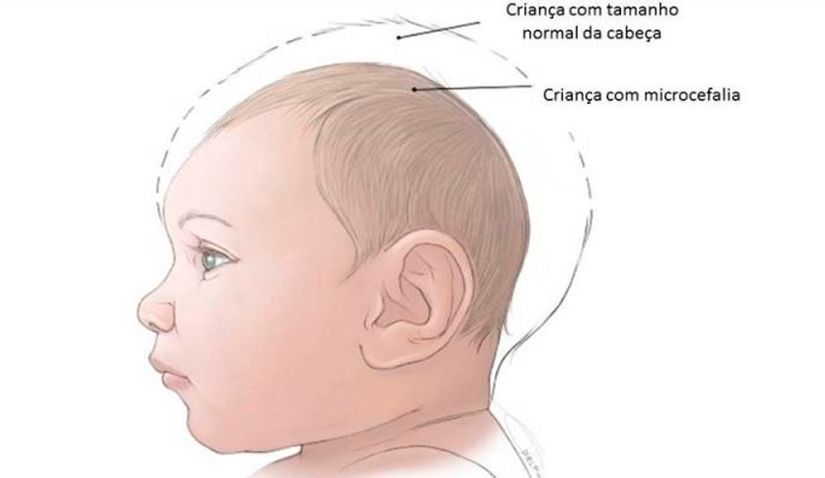  Vigilância Epidemiológica notifica novos casos suspeitos de microcefalia