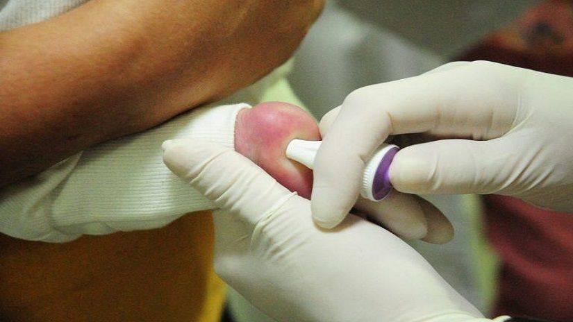 O Teste do Pezinho ou Triagem Neonatal é a forma mais efetiva e precoce de detectar a anemia falciforme Crédito - Breno Esaki | Agência Saúd